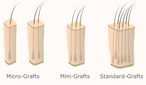 Abbildung 2: Einteilung von Grafts anhand ihrer Grösse. Eigene Darstellung: Micro-Grafts mit ein bis zwei Haaren, Mini-Grafts mit drei Haaren und Standard-Grafts mit mehr Haaren