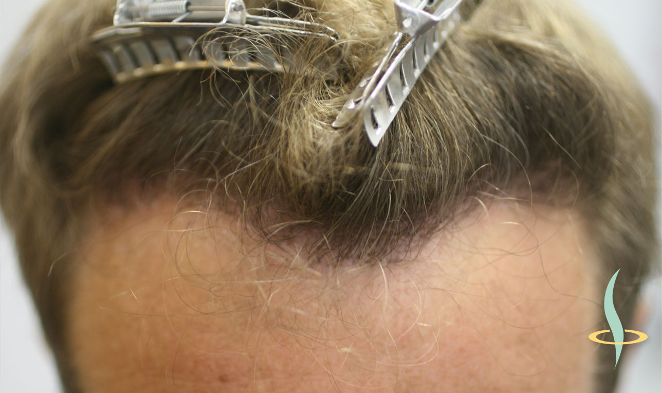 Immagine 11: Attaccatura dei capelli dopo l’autotrapianto.
