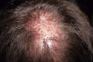 Infiammazioni visibili e tessuto cicatriziale dovuti a impianti di capelli artificiali sul cuoio capelluto di un uomo; dettaglio primo piano