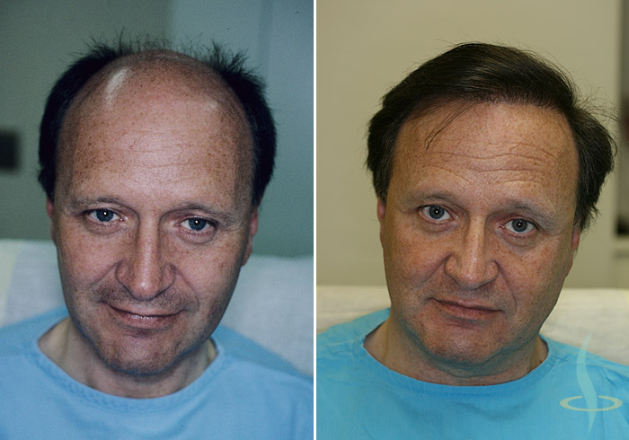    A sinistra: prima / a destra: dopo 3° operazione