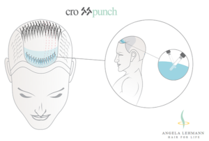 Nuovo articolo sul trapianto di capelli auto pubblicato con il metodo crosspunch