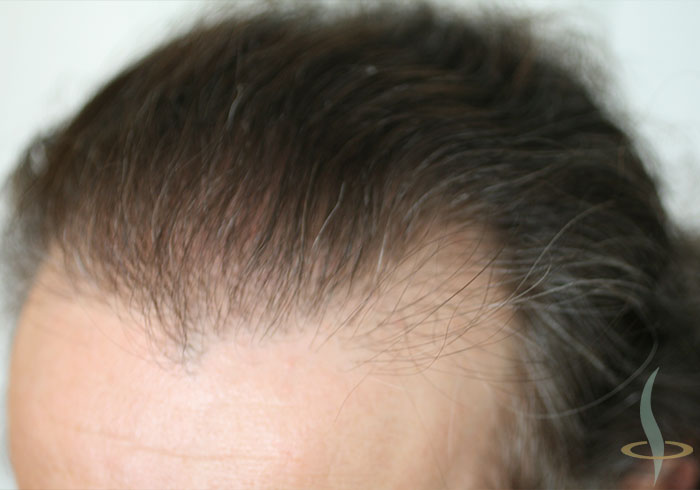 Attaccatura dei capelli a sinistra dopo la seconda operazione
