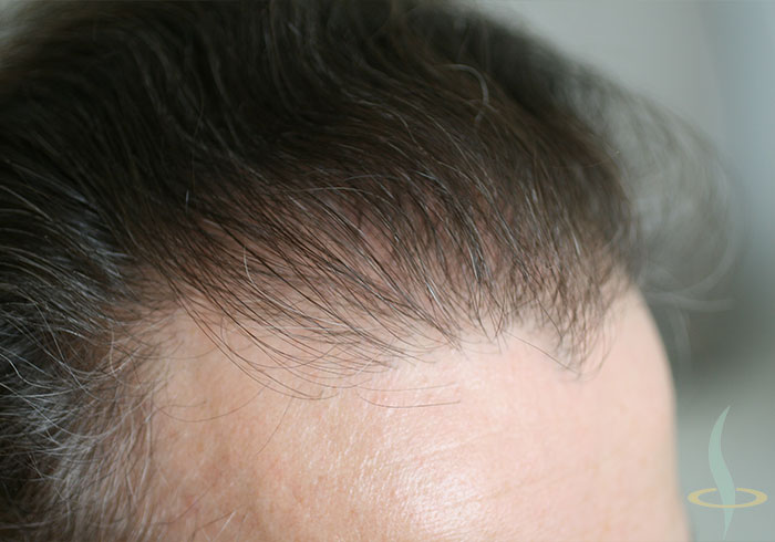 Attaccatura dei capelli a destra dopo la seconda operazione
