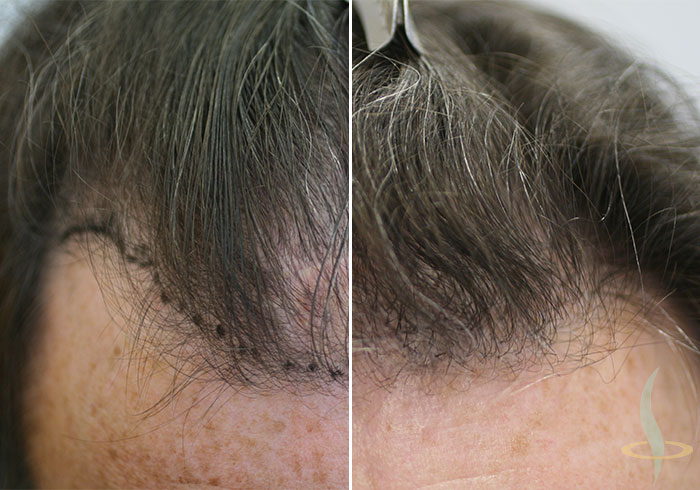 Prima e dopo il 2° intervento